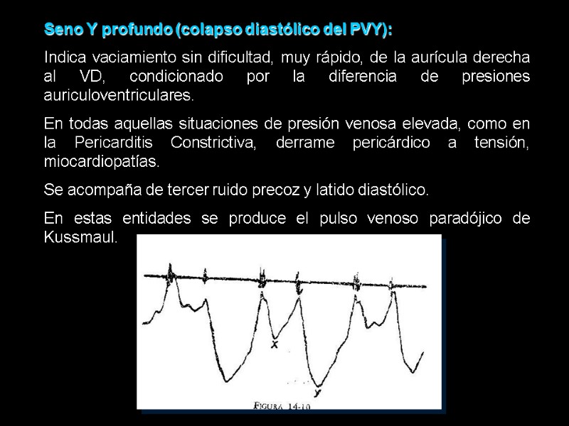 Seno Y profundo (colapso diastólico del PVY): Indica vaciamiento sin dificultad, muy rápido, de